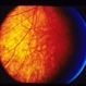 Ocular Albinism Carrier Ocular Albinism Carrier