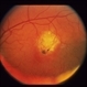 ARMD Laser Rx ARMD Laser Rx