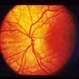 Ocular Albinism Carrier Ocular Albinism Carrier