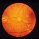 Ocular Albinism Carrier Ocular Albinism Carrier