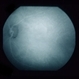 Abnormal Fundus