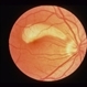 Superior Paracentral Scotoma
