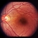 Bilateral Serous Detachments