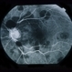 Sub-Arachnoid Hemorrhage