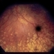 Nummular Depigmented Or Atrophic Pigment Epithelium