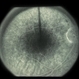 Paracentral Blind Spot And Scotoma