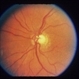 Optic And Hyperemic Disc And Hyperemic Rim