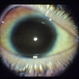 Retinal Vascular Occlusive Disease