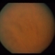 Intraocular Inflammation
