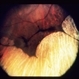 Gyrate Atrophy