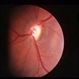 Optic Nerve Hypoplasia
