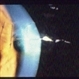 Corneal Laceration / Repeat Trauma