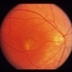 Idiopathic Choroidal Neovasculization (CNV)