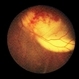 CMV Chorioretinitis