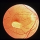 Superior Paracentral Scotoma