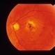 Idiopathic Polypoidal Choroidal Vasculopathy