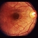 Bilateral Serous Detachments