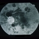 Sub-Arachnoid Hemorrhage