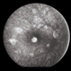 Decreased Visual Acuity (Case 2)