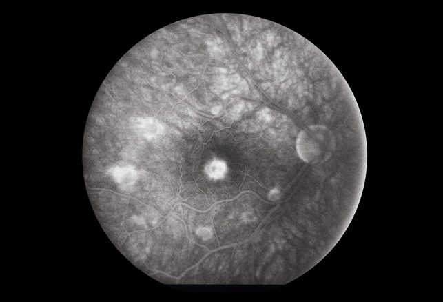 decreased visual acuity icd 10 code