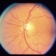 Optic And Hyperemic Disc And Hyperemic Rim