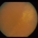 Intraocular Inflammation
