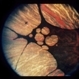 Gyrate Atrophy