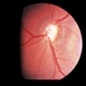 Optic Nerve Hypoplasia