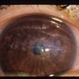 Corneal Laceration / Repeat Trauma