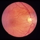 Normal Retina
