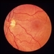 Normal Retina