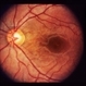 Bilateral Serous Detachments