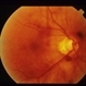 Sub-Arachnoid Hemorrhage