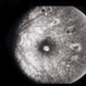 Decreased Visual Acuity (Case 2)