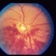 Optic And Hyperemic Disc And Hyperemic Rim