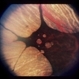 Gyrate Atrophy