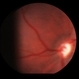 Optic Nerve Hypoplasia