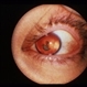 Aniridia With Glaucoma