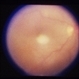 Toxoplasmosis Active Toxoplasmosis Active