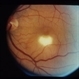 ARMD - CNV and Subretinal Fluid  Post Thermal Laser ARMD - CNV and Subretinal Fluid  Post Thermal Laser