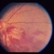 Optic And Hyperemic Disc And Hyperemic Rim