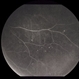 Retinal Vascular Occlusive Disease