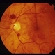 Sub-Arachnoid Hemorrhage