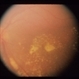 Intraocular Inflammation