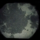 Acute Multifocal Placoid Pigment Epitheliopathy (AMPPE)