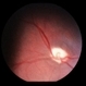 Optic Nerve Hypoplasia