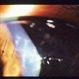 Corneal Laceration / Repeat Trauma