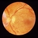 Acute optic nerve edema due to JODM