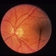 Acute Macular Neororetinitis Acute Macular Neororetinitis
