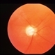 Aniridia With Glaucoma